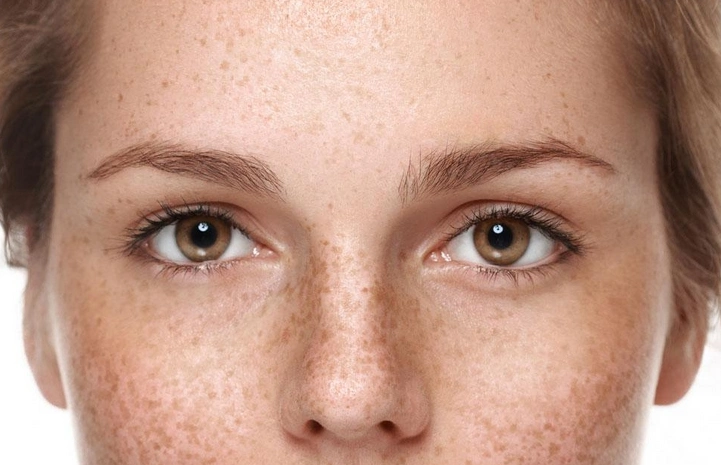 淡斑把握4个技巧,短时间斑点能消失