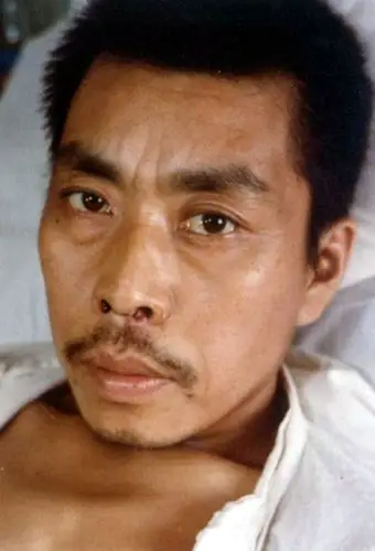 乙肝患者图片面容