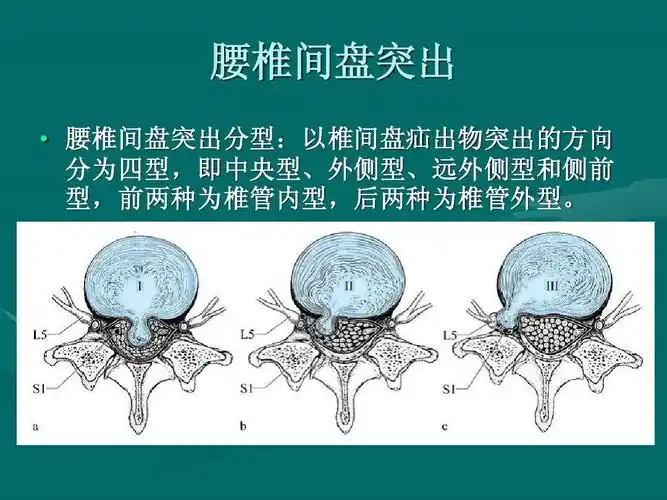 腰椎间盘的mri诊断ppt