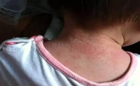 婴儿长痱子怎么办婴儿起痱子用什么方法最有效