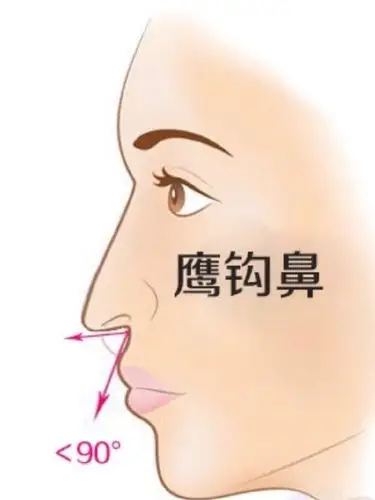 什么是鹰钩鼻