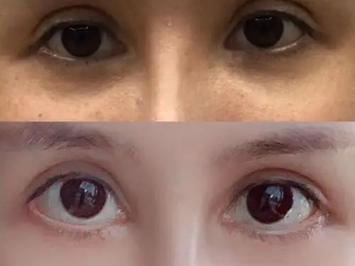 本人外眼角77下至77外切眼袋手术前后对比