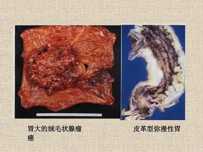 胃大的绒毛状腺瘤 癌 皮革型弥漫性胃