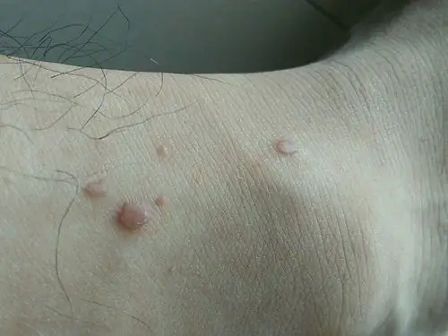 请问一下这是鱼痣吗?不疼不痒就是影响美观,手上也有一些小的乳白色