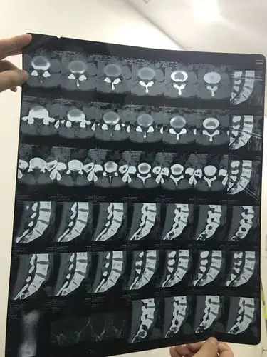 骶椎腰化 l4/5椎间盘膨出 l5/6椎间盘突出 右侧腰和臀部疼痛 医生说让