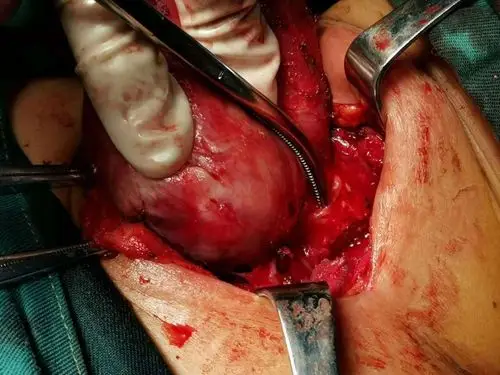 术中仔细操作分离,结扎重要血管,保护甲状旁腺,喉返神经