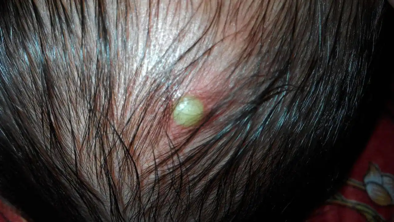 宝宝出生九天了 ,头上长了脓包,昨天还小今天打了好多 请问医生该如何