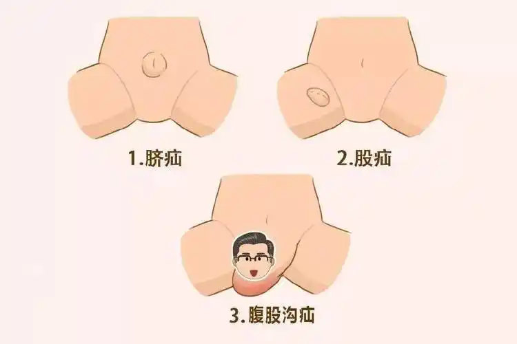 真可怕小儿大腿根部鼓起一个包医生说处理不当有可能会影响将来的生育