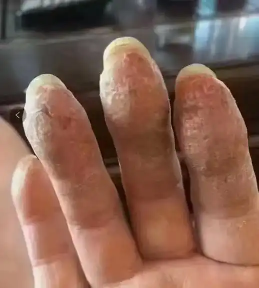 皲裂性湿疹:是一种慢性的常见的皮肤病,因常在冬季出现掌跖部 - 抖音