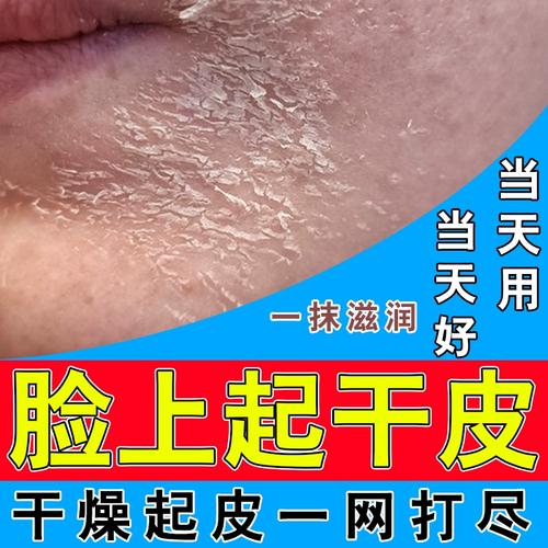 脸皮肤干燥起皮脸上起干皮爆皮脱皮眼有碎屑起癣长癣用什么护肤品