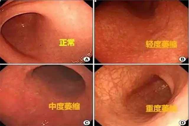 慢性萎缩性胃炎胃镜与病理诊断的符合性研究慢性萎缩性胃炎胃镜与病理