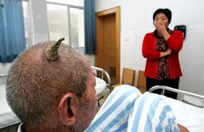 88岁老人头上长犄角,专家称其实并不罕见_闽商网