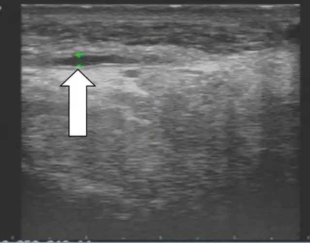 梗阻性无精子症的超声定位诊断_输精管
