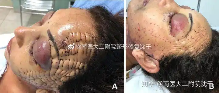 介绍一个比较有创意的提眉手术.