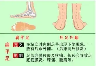 扁平足造成足外翻及x型腿的原因-深圳远恒康复公司 s blog -网商在线