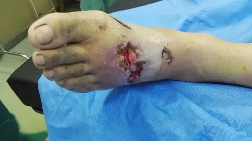 机器压伤足背肌腱外露
