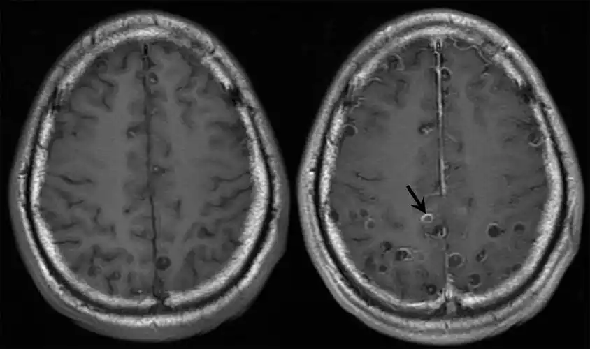 一文读懂脑囊虫病的影像学表现