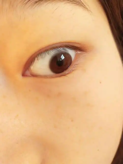 眼瞳上面灰色的是什么,好像要脱落一样_百度知道