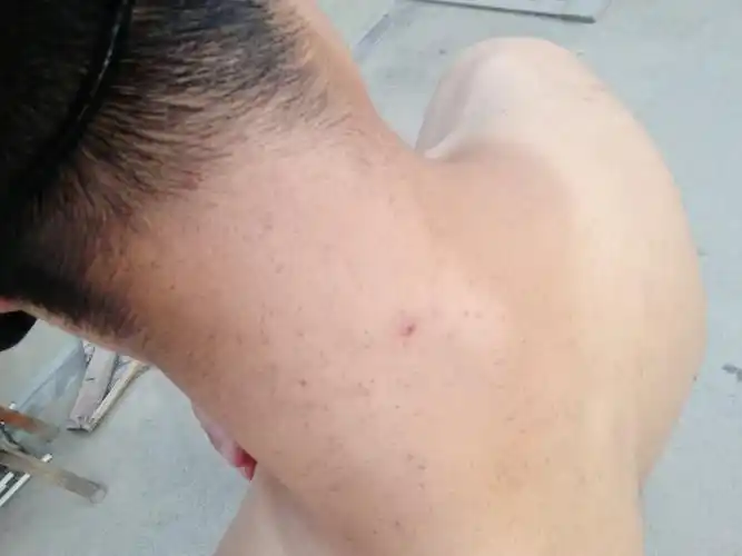 背部和颈部皮肤,有很多这种黑色的小坑,是怎么回事?怎么治疗和改善