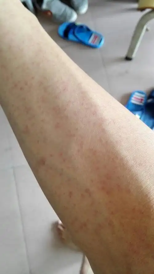 今早起来突然发现身上有这些小红点,满身都是.但是不怎么痒.