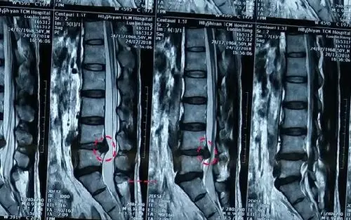 其它 巨大突出物椎间孔镜取出 写美篇腰椎磁共振示:腰4―5椎间盘髓核