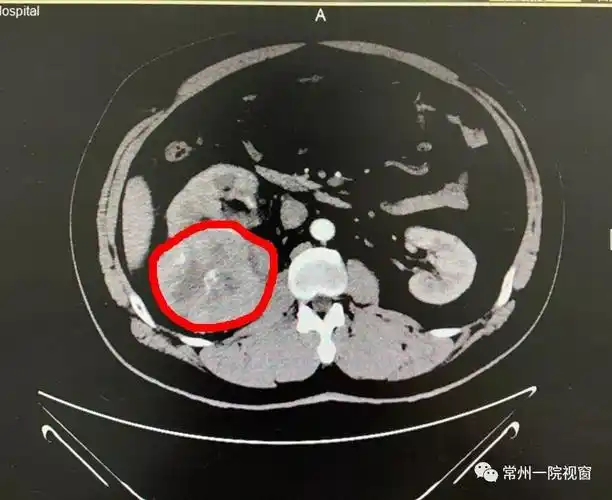 "右侧肾脏有一个直径约10cm的血肿,可能是肿瘤而且已经局部破裂,导致