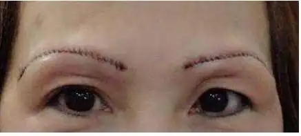 提眉术失败图片,作精二姐提眉后有一条线的疤痕,瞬间泄气了