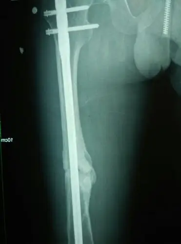 2015年5月份我大腿骨折手术已经三个月了,不甘寂寞的我就开始得瑟了