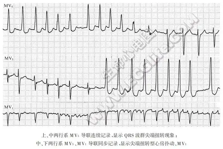 尖端扭转型心房扑动或心房颤动伴qrs波群尖端扭转现象心电图