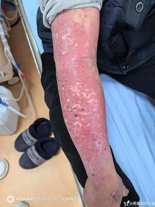 求问这个是静脉炎丹毒蜂窝织炎表皮坏死松解症