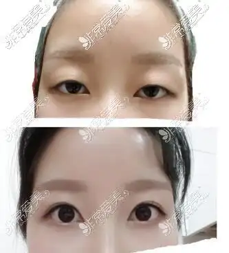 韩国突眼眼球外凸双眼皮成功案例