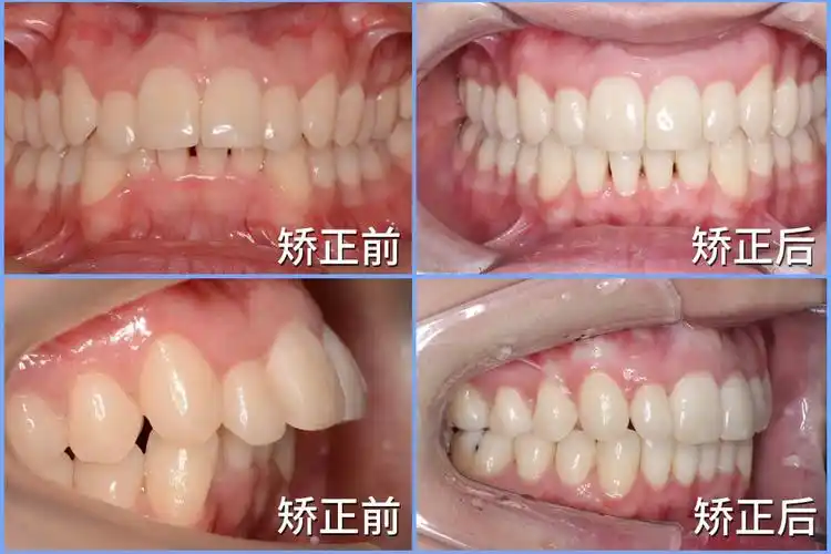 拔智齿推磨牙隐适美矫正让她悄悄变美