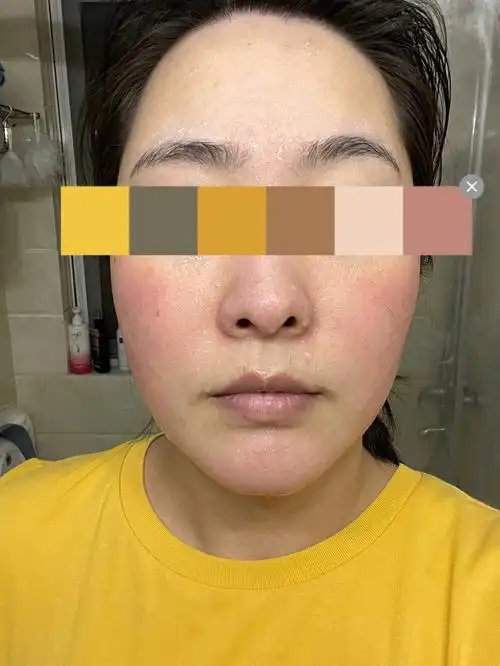 玫瑰痤疮治疗第61天光子嫩肤第6天