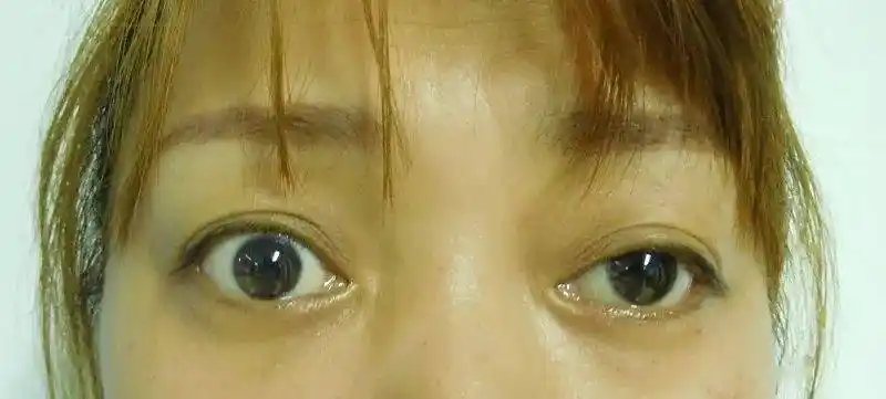 眼球突出几近失明青岛市民跨越1684公里成功将眼球还回去