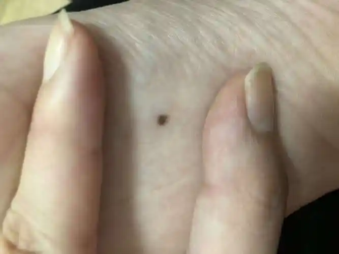 揭秘!盘点黑色素瘤早期症状"孕妇打呼"-第2张图片-峥嵘博客