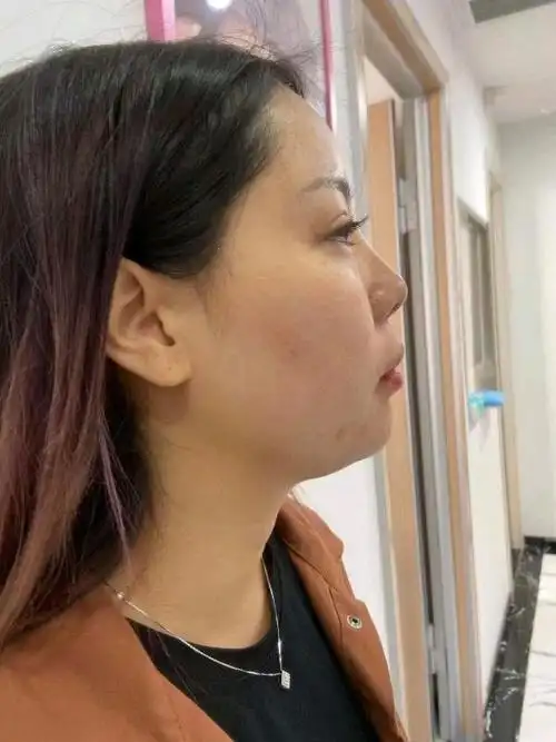 不知道自己是不是风字脸,脸两边的肉很明显的凸出了起_圈子-新氧美容