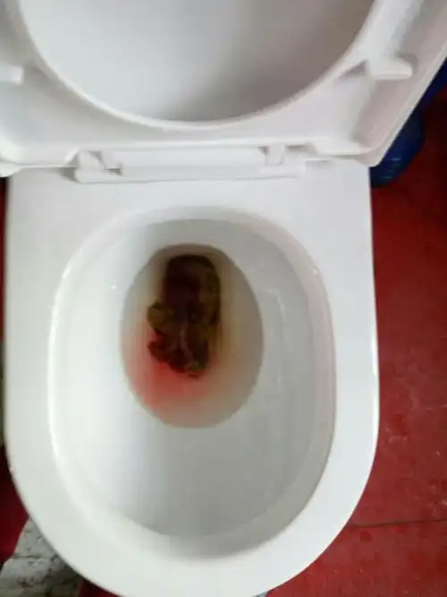 13岁小孩拉大便有血,拉完后屁股辣辣的