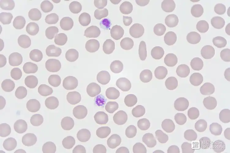 血小板何故如此低血涂片下见真章