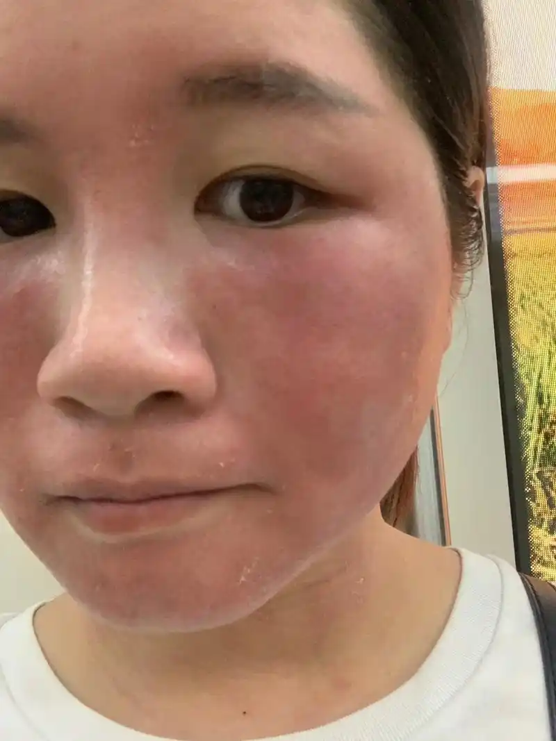 #激素脸 #敏感肌 #修复红血丝角质层薄 #问题性皮肤 - 抖音