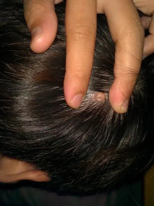 头部右后头皮长了个小肉疙瘩不疼不痒比较软不知道