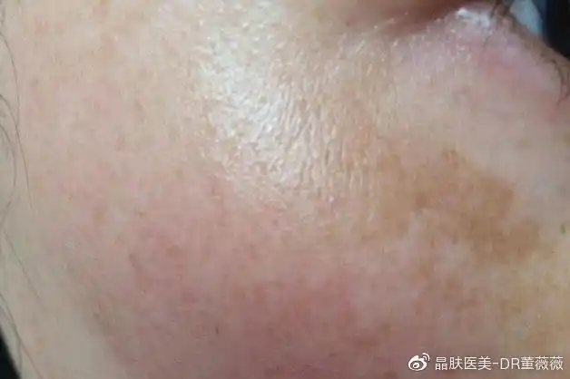 形态:面颊两侧块状分布的黄褐色斑块67常见位置:眼眶附近,额头,两颊