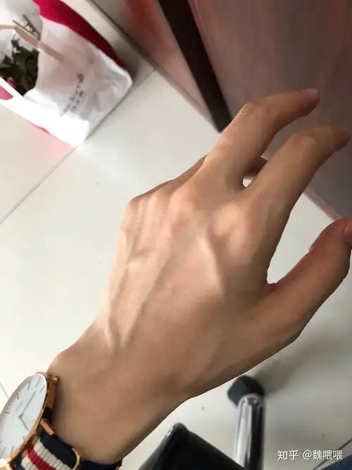从小手上青筋凸起超级严重,像动漫里的一样,我觉得是没得治了,请问有