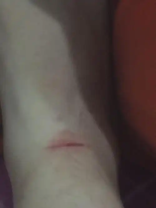 脚上不小心被玻璃渣划破了要不要打破伤风