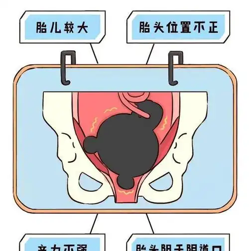 头盆不称,胎位异常,胎儿窘迫,产道畸形,外阴疾病,妊娠合并症和并发症