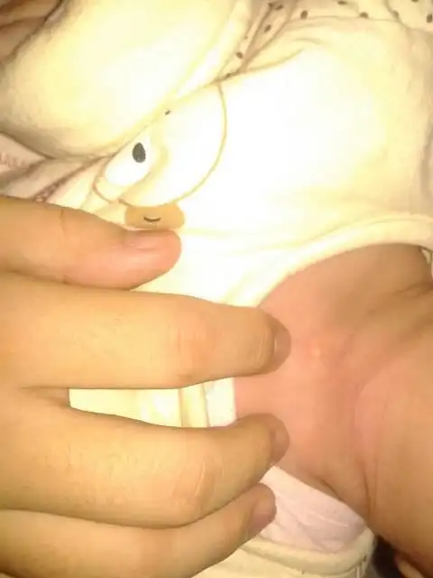 新生儿锁骨位置表皮内长一米粒状疙瘩,现刚满月,刚出生后就有