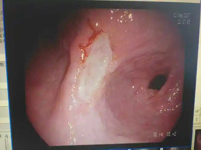 胃的结构图详解胃糜烂和胃溃疡哪个更严重