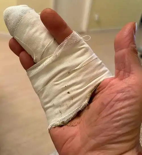 "西门庆"单立文近况引担忧!受伤4个月仍未痊愈,手指缠满纱布