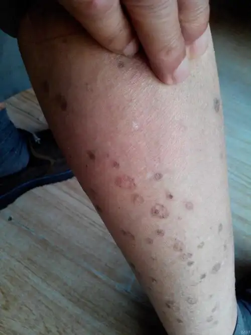 请问这是什么病经大家会诊汗孔角化症争做良医