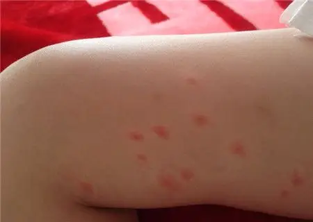 人被跳蚤咬后症状图片