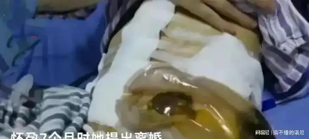 四川29岁女子自曝长期被家暴肠子被打断终生挂粪袋生活